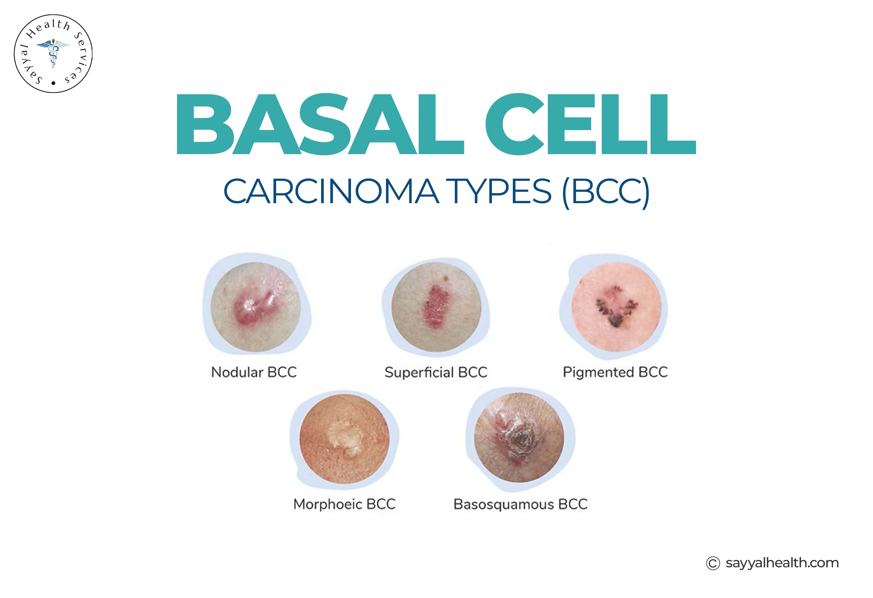 Basal Cell Carcinoma